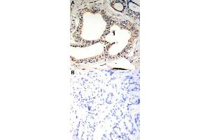 Immunohistochemical staining of human breast cancer tissue by Nfkbie (phospho S22) polyclonal antibody  without blocking peptide (A) or preincubated with blocking peptide (B) under 1:50-1:100 dilution. (NFKBIE 抗体  (pSer22))