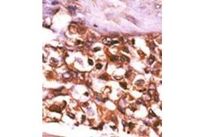 Formalin-fixed and paraffin-embedded human cancer tissue (hepatocarcinoma) reacted with the primary antibody, which was peroxidase-conjugated to the secondary antibody, followed by AEC staining. (Ribokinase 抗体  (N-Term))