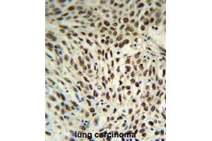 SNRPD3 Antibody (C-term) IHC analysis in formalin fixed and paraffin embedded human lung carcinoma followed by peroxidase conjugation of the secondary antibody and DAB staining. (SNRPD3 抗体  (C-Term))