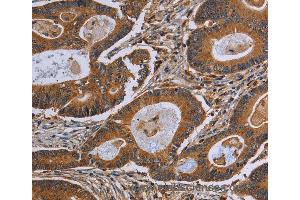 Immunohistochemistry of Human colon cancer using GJB4 Polyclonal Antibody at dilution of 1:40 (GJB4 抗体)