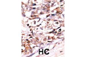 Formalin-fixed and paraffin-embedded human hepatocellular carcinoma tissue reacted with DUSP13 polyclonal antibody  , which was peroxidase-conjugated to the secondary antibody, followed by AEC staining. (DUSP13 抗体  (N-Term))