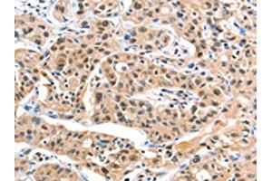 The image on the left is immunohistochemistry of paraffin-embedded Human liver cancer tissue using ABIN7129182(DDX4 Antibody) at dilution 1/20, on the right is treated with fusion protein. (DDX4 抗体)