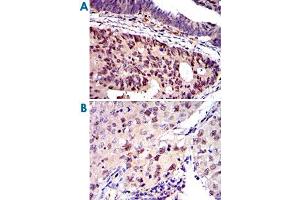 Immunohistochemical analysis of paraffin-embedded human colon cancer (A) and human lung cancer (B) tissues using MCM2 monoclonal antibody, clone 2B3  with DAB staining. (MCM2 抗体)