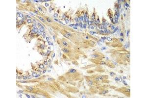 Immunohistochemistry of paraffin-embedded Human prostate using PICK1 Polyclonal Antibody at dilution of 1:100 (40x lens). (PICK1 抗体)