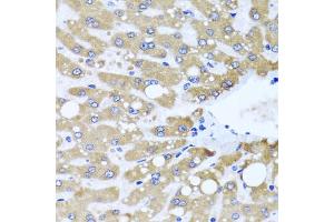 Immunohistochemistry of paraffin-embedded human liver injury using NDUFS3 antibody (ABIN5974479) at dilution of 1/100 (40x lens). (NDUFS3 抗体)