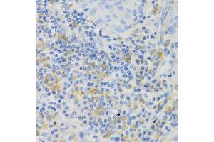Immunohistochemistry of paraffin-embedded human lung cancer using PAK1 Antibody (ABIN5971674) at dilution of 1/100 (40x lens). (PAK1 抗体)