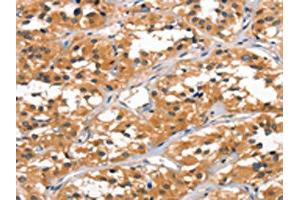 The image on the left is immunohistochemistry of paraffin-embedded Human thyroid cancer tissue using ABIN7189781(ALOX15 Antibody) at dilution 1/60, on the right is treated with synthetic peptide. (ALOX15 抗体)
