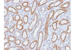 Formalin-fixed, paraffin-embedded human Renal Cell Carcinoma stained with CD61 Rabbit Recombinant Monoclonal Antibody (ITGB3/2166R). (Recombinant Integrin beta 3 抗体  (AA 385-490))