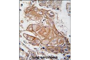 Formalin-fixed and paraffin-embedded human lung carcinoma tissue reacted with Phospho-RGS19-pS151.