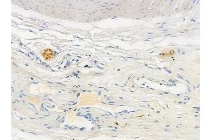 ABIN6256307 and ABIN6267423 at 1/100 staining human testicular cancer by IHC-P. (ELK1 抗体  (pSer383))