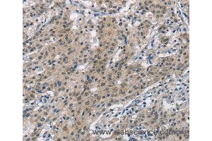 Immunohistochemistry of Human gastric cancer using SMAD9 Polyclonal Antibody at dilution of 1:30 (SMAD9 抗体)