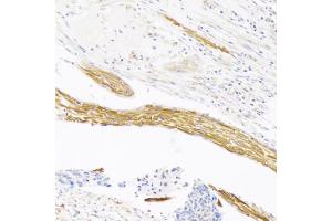 Immunohistochemistry of paraffin-embedded human esophageal cancer using VASH1 antibody (ABIN6290544) at dilution of 1:100 (20x lens). (VASH1 抗体)