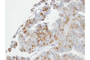 IHC-P Image Immunohistochemical analysis of paraffin-embedded GSTA2 xenograft, using GSTO1, antibody at 1:100 dilution. (GSTO1 抗体)