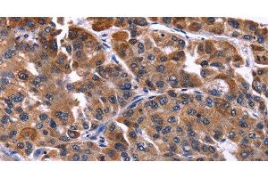 Immunohistochemistry of paraffin-embedded Human liver cancer tissue using NFATC3 Polyclonal Antibody at dilution 1:50 (NFATC3 抗体)