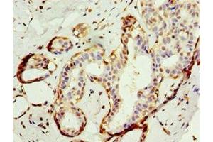 Immunohistochemistry of paraffin-embedded human breast cancer using ABIN7144041 at dilution of 1:100 (Amyloid beta (A4) Precursor Protein-Binding, Family B, Member 1 Interacting Protein (APBB1IP) (AA 1-150) 抗体)