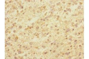 Immunohistochemistry of paraffin-embedded human glioma using ABIN7148481 at dilution of 1:100 (CNTNAP1 抗体  (AA 20-300))