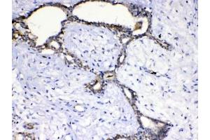 IHC testing of FFPE human breast cancer tissue with SCF antibody at 1ug/ml. (KIT Ligand 抗体)