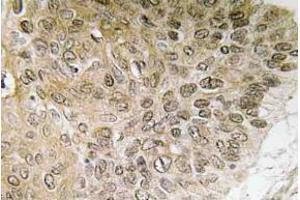 Immunohistochemistry (IHC) analyzes of PI 3-kinase p85alpha antibody in paraffin-embedded human lung carcinoma tissue. (PIK3R1 抗体)