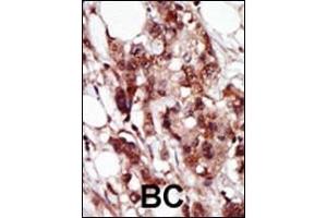 Formalin-fixed and paraffin-embedded human cancer tissue reacted with the primary antibody, which was peroxidase-conjugated to the secondary antibody, followed by AEC staining. (BRD4 抗体  (C-Term))