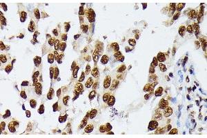 Immunohistochemistry of paraffin-embedded Human lung cancer using HNRNPD Polyclonal Antibody at dilution of 1:100 (40x lens). (HNRNPD/AUF1 抗体)