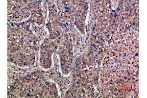 Immunohistochemical analysis of paraffin-embedded human-lung-cancer, antibody was diluted at 1:200 (IFNAR1 抗体  (AA 300-350))