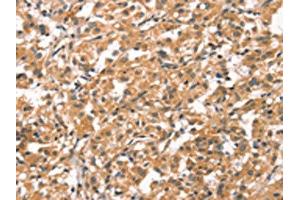 The image on the left is immunohistochemistry of paraffin-embedded Human thyroid cancer tissue using ABIN7190421(CYP46A1 Antibody) at dilution 1/15, on the right is treated with synthetic peptide. (CYP46A1 抗体)