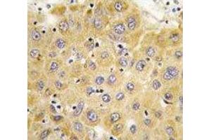 IHC analysis of FFPE human hepatocarcinoma tissue stained with Connective Tissue Growth Factor antibody (CTGF 抗体  (AA 315-349))