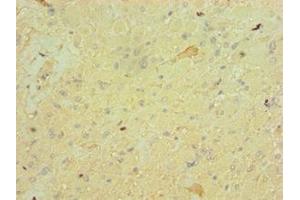 Immunohistochemistry of paraffin-embedded human glioma using ABIN7152828 at dilution of 1:100 (FGF9 抗体  (AA 1-208))
