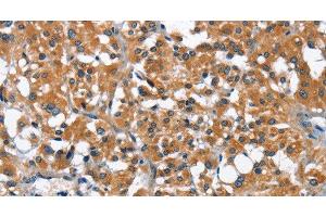 Immunohistochemistry of paraffin-embedded Human thyroid cancer using ARMCX2 Polyclonal Antibody at dilution of 1:40 (ARMCX2 抗体)
