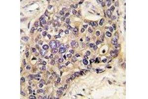 IHC analysis of FFPE human hepatocarcinoma tissue stained with HGF antibody (HGF 抗体  (AA 521-554))
