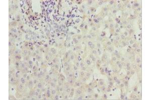 Immunohistochemistry of paraffin-embedded human liver cancer using ABIN7176529 at dilution of 1:100 (ZNF785 抗体  (AA 1-200))