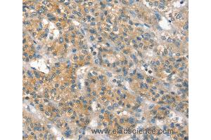 Immunohistochemistry of Human liver cancer using PPP2CA Polyclonal Antibody at dilution of 1:35 (PPP2CA 抗体)