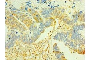 Immunohistochemistry of paraffin-embedded human ovarian cancer using ABIN7158358 at dilution of 1:100 (LIMK2 抗体  (AA 1-240))
