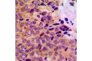 Immunohistochemical analysis of MMP8 staining in human breast cancer formalin fixed paraffin embedded tissue section. (MMP8 抗体  (C-Term))