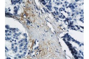 Formalin-fixed and paraffin embedded human breast cancer labeled with Anti MT-ND6 Polyclonal Antibody, Unconjugated  followed by conjugation to the secondary antibody and DAB staining (MT-ND6 抗体  (AA 51-150))