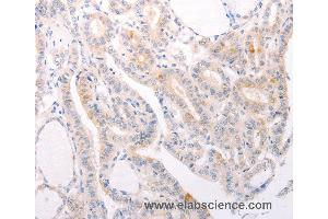 Immunohistochemistry of Human thyroid cancer using S1PR3 Polyclonal Antibody at dilution of 1:30 (S1PR3 抗体)