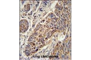CYC1 Antibody (C-term) (ABIN651531 and ABIN2840281) immunohistochemistry analysis in formalin fixed and paraffin embedded human lung carcinoma followed by peroxidase conjugation of the secondary antibody and DAB staining. (Cytochrome C1 抗体  (C-Term))