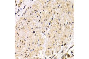 Immunohistochemistry of paraffin-embedded human stomach cancer using TMPRSS2 antibody at dilution of 1:200 (400x lens). (TMPRSS2 抗体)