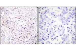 Immunohistochemistry analysis of paraffin-embedded human breast carcinoma tissue, using SENP3 Antibody.