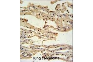 IFM2 Antibody (N-term) (ABIN650963 and ABIN2840011) IHC analysis in formalin fixed and paraffin embedded lung carcinoma followed by peroxidase conjugation of the secondary antibody and DAB staining. (IFITM2 抗体  (N-Term))