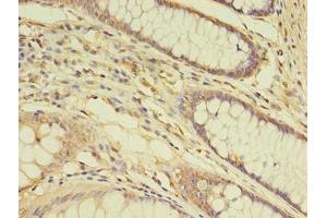 Immunohistochemistry of paraffin-embedded human colon cancer using ABIN7172148 at dilution of 1:100 (THRA 抗体  (AA 1-490))