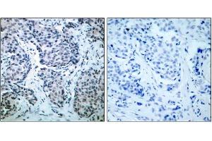 Immunohistochemical analysis of paraffin-embedded human breast carcinoma tissue, using SEK1/MKK4(phospho-Thr261)antibody (E011176). (MAP2K4 抗体  (pThr261))