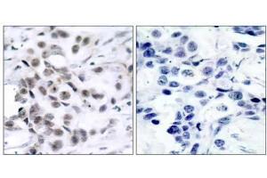 Immunohistochemical analysis of paraffin-embedded human breast carcinoma tissue using Chk1 (Ab-317) antibody (E021114). (CHEK1 抗体)