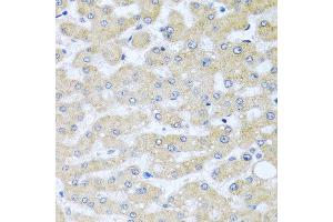 Immunohistochemistry of paraffin-embedded human liver injury using BCKDK antibody at dilution of 1:100 (x40 lens).