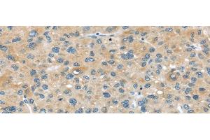 Immunohistochemistry of paraffin-embedded Human liver cancer tissue using ABCC2 Polyclonal Antibody at dilution 1:45 (ABCC2 抗体)