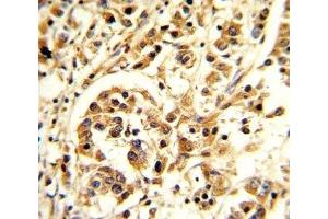 IHC analysis of FFPE human breast carcinoma stained with IL-12 antibody (IL12 抗体  (AA 168-195))