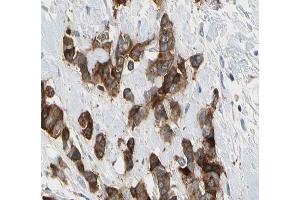 ABIN6266575 at 1/200 staining human breast carcinoma tissue sections by IHC-P. (Cytokeratin 7 抗体  (C-Term))