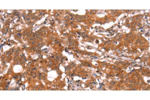 Immunohistochemistry of paraffin-embedded Human gastric cancer using FUT1 Polyclonal Antibody at dilution of 1:30 (FUT1 抗体)