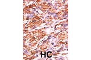 Formalin-fixed and paraffin-embedded human cancer tissue reacted with the primary antibody, which was peroxidase-conjugated to the secondary antibody, followed by AEC staining. (Retinoblastoma 1 抗体  (pSer811))