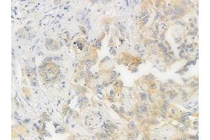 ABIN6256377 and ABIN6267565 at 1/100 staining human tongue carcinoma by IHC-P. (14-3-3 zeta 抗体  (pSer58))